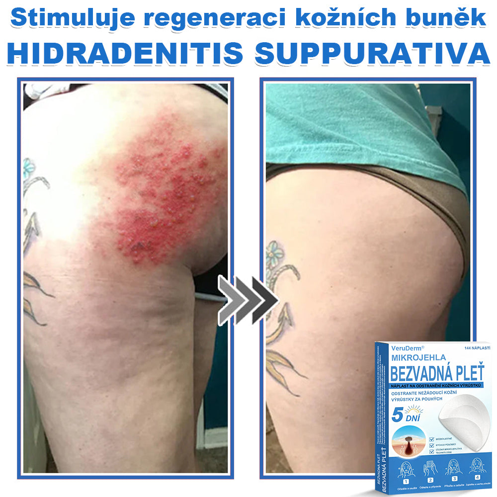 VeruDerm® 2v1 mikrojehličková a hydrokoloidní náplast | Cílená péče o kožní výrůstky, pupínky, ploché bradavice a drobné nedokonalosti ✅ | Pomáhá zjemnit vzhled vrásek, jizev a nerovností pleti ✨ | Diskrétní náplast na obličej i tělo | 144 ks