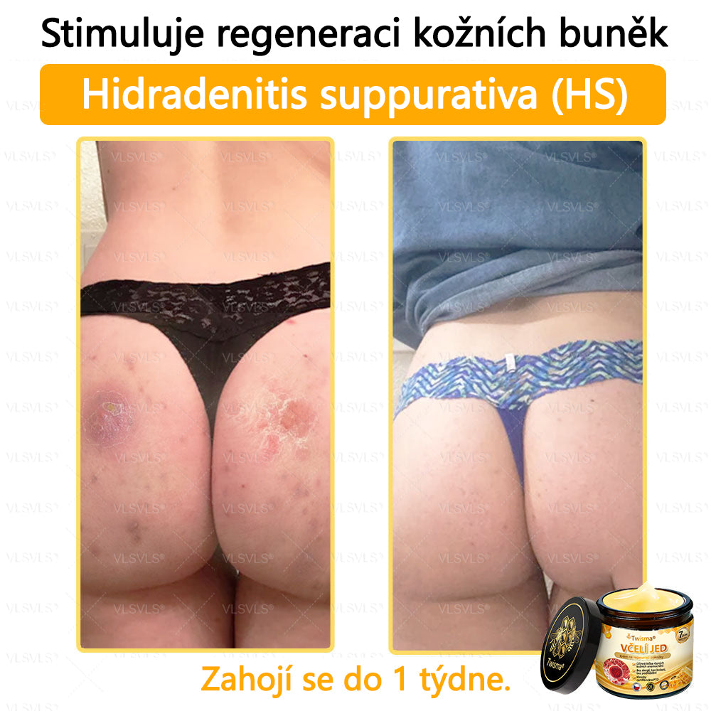🐝Twisma® Krém s včelím jedem – doporučeno kožními lékaři 🧑‍⚕️ Na různé kožní problémy – fakt účinný a šetrný pomocník