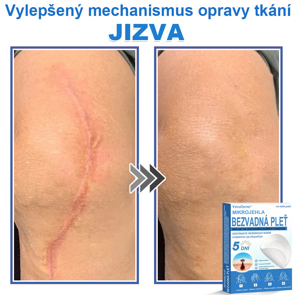 VeruDerm® 2v1 mikrojehličková a hydrokoloidní náplast | Cílená péče o kožní výrůstky, pupínky, ploché bradavice a drobné nedokonalosti ✅ | Pomáhá zjemnit vzhled vrásek, jizev a nerovností pleti ✨ | Diskrétní náplast na obličej i tělo | 144 ks