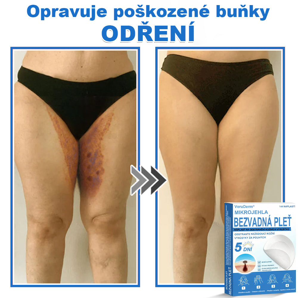 VeruDerm® 2v1 mikrojehličková a hydrokoloidní náplast | Cílená péče o kožní výrůstky, pupínky, ploché bradavice a drobné nedokonalosti ✅ | Pomáhá zjemnit vzhled vrásek, jizev a nerovností pleti ✨ | Diskrétní náplast na obličej i tělo | 144 ks