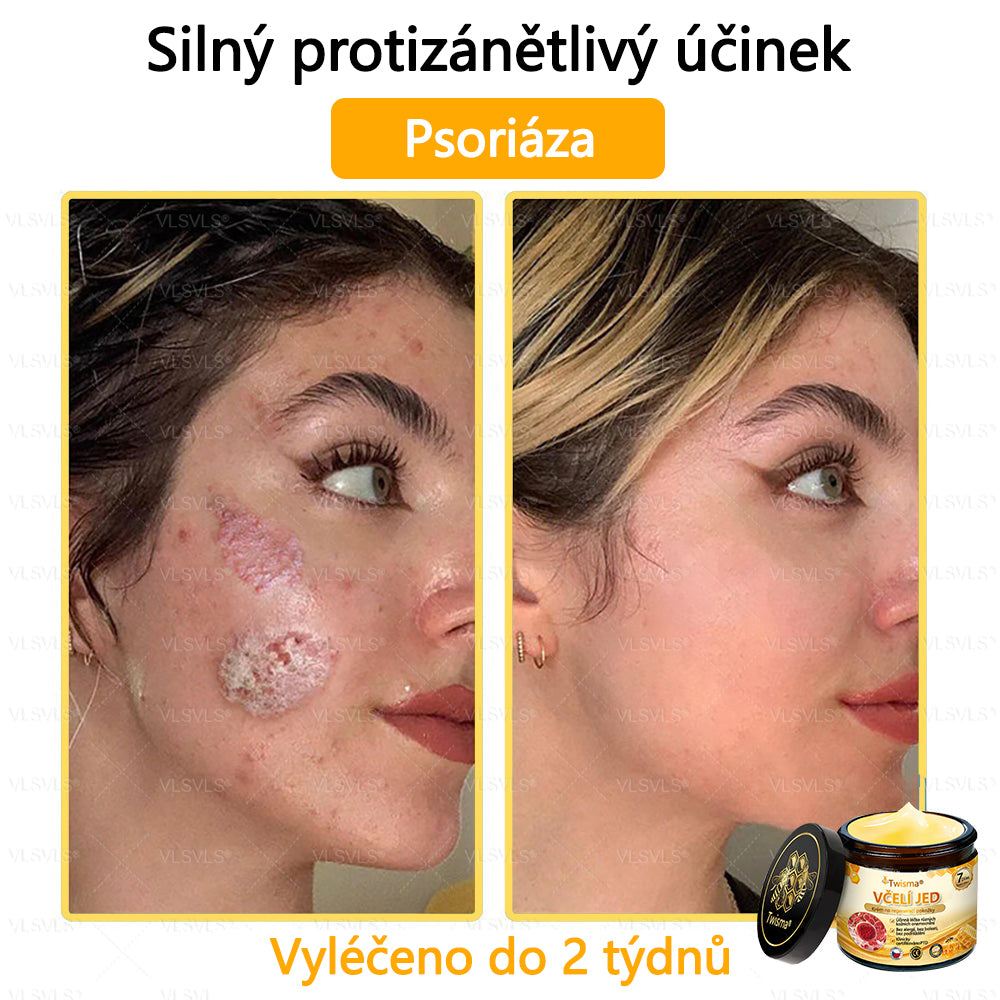 🐝Twisma® Krém s včelím jedem – doporučeno kožními lékaři 🧑‍⚕️ Na různé kožní problémy – fakt účinný a šetrný pomocník