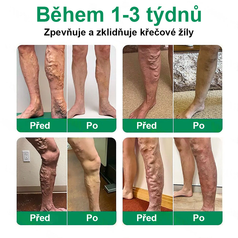 ✨ Twisma® VeinTarget – Pokročilá mikro náplast na křečové žíly 🔥 96 % klinicky prokázaná účinnost ⚡ Viditelné výsledky už za 7–14 dní 🌿 Šetrná podpora pro lehčí a uvolněnější nohy 🦵💪