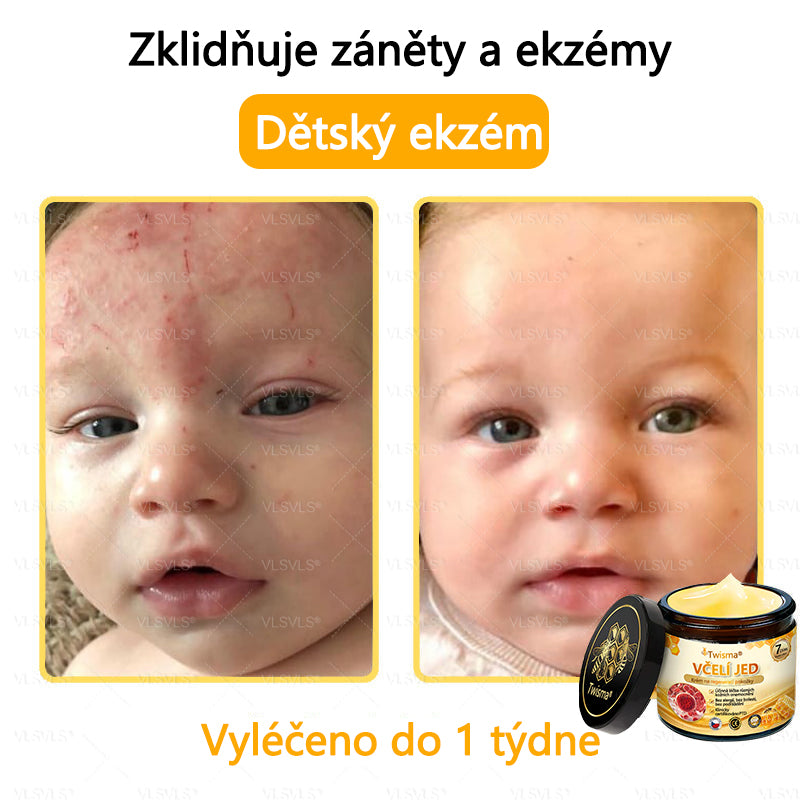 🐝Twisma® Krém s včelím jedem – doporučeno kožními lékaři 🧑‍⚕️ Na různé kožní problémy – fakt účinný a šetrný pomocník