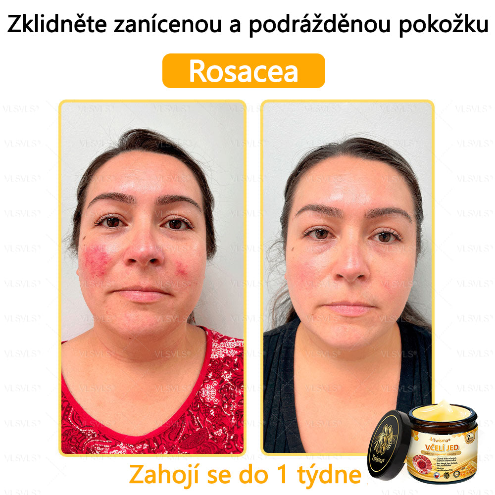 🐝Twisma® Krém s včelím jedem – doporučeno kožními lékaři 🧑‍⚕️ Na různé kožní problémy – fakt účinný a šetrný pomocník