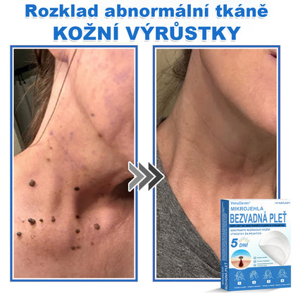 VeruDerm® 2v1 mikrojehličková a hydrokoloidní náplast | Cílená péče o kožní výrůstky, pupínky, ploché bradavice a drobné nedokonalosti ✅ | Pomáhá zjemnit vzhled vrásek, jizev a nerovností pleti ✨ | Diskrétní náplast na obličej i tělo | 144 ks