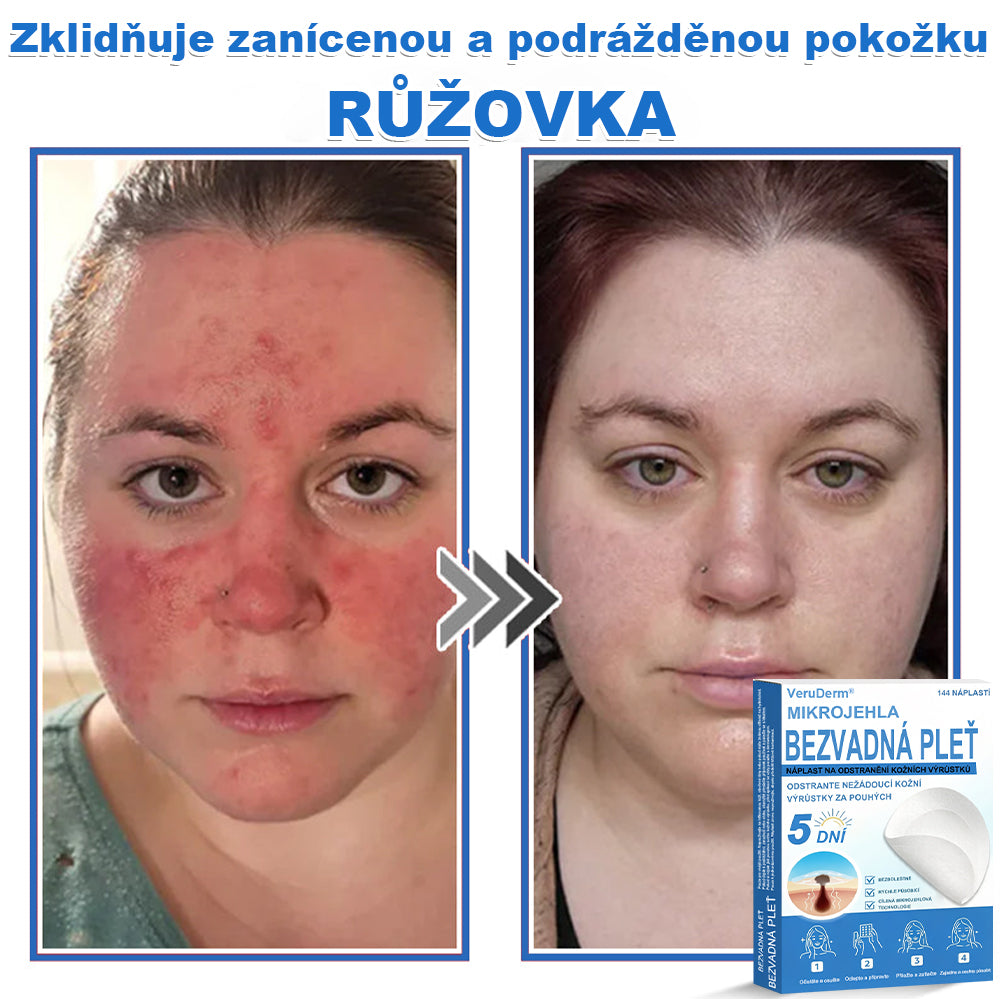 VeruDerm® 2v1 mikrojehličková a hydrokoloidní náplast | Cílená péče o kožní výrůstky, pupínky, ploché bradavice a drobné nedokonalosti ✅ | Pomáhá zjemnit vzhled vrásek, jizev a nerovností pleti ✨ | Diskrétní náplast na obličej i tělo | 144 ks