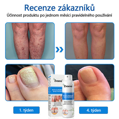 💪 Oficiální obchod: Twisma® Magnesium bylinný sprej na lupénku ✅ CE certifikace (zmírňuje lupénku a ekzém, léčí akné a bradavice, podporuje hojení bakteriálních infekcí, snižuje kloubní a neuropatickou bolest)