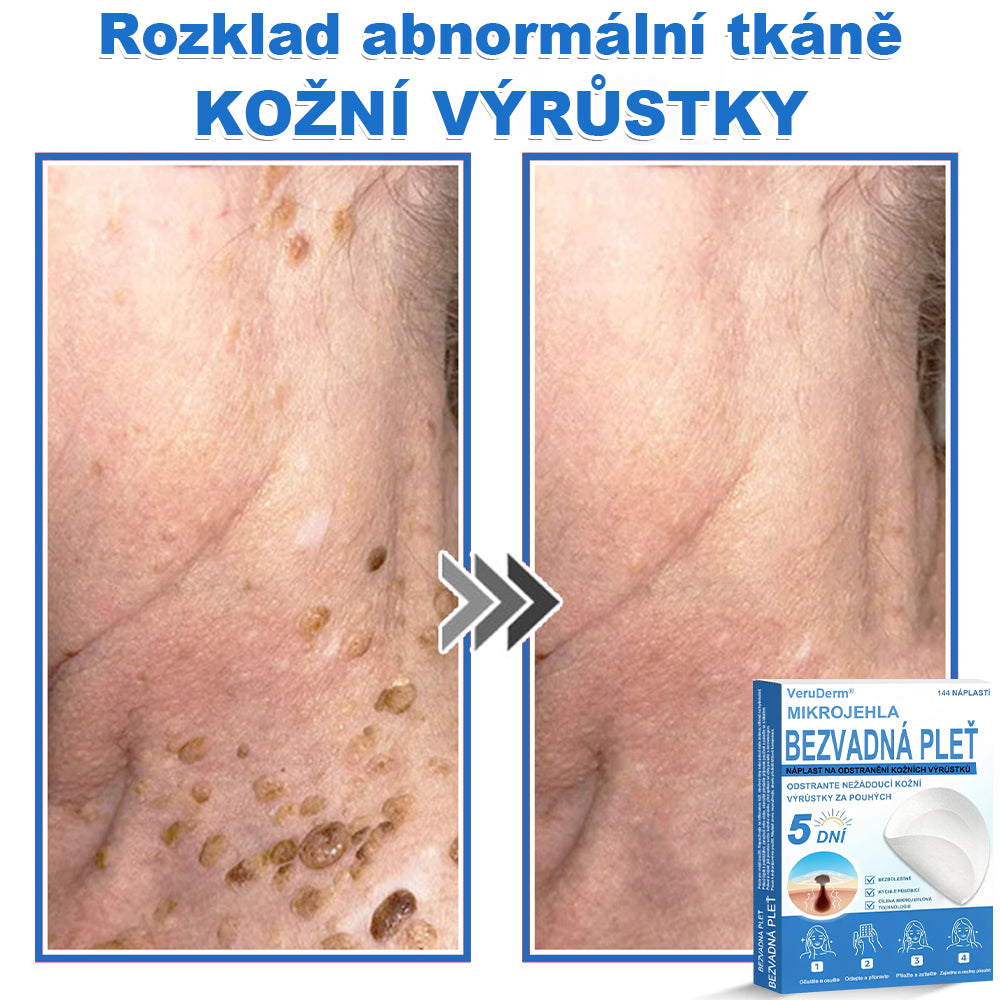 VeruDerm® 2v1 mikrojehličková a hydrokoloidní náplast | Cílená péče o kožní výrůstky, pupínky, ploché bradavice a drobné nedokonalosti ✅ | Pomáhá zjemnit vzhled vrásek, jizev a nerovností pleti ✨ | Diskrétní náplast na obličej i tělo | 144 ks