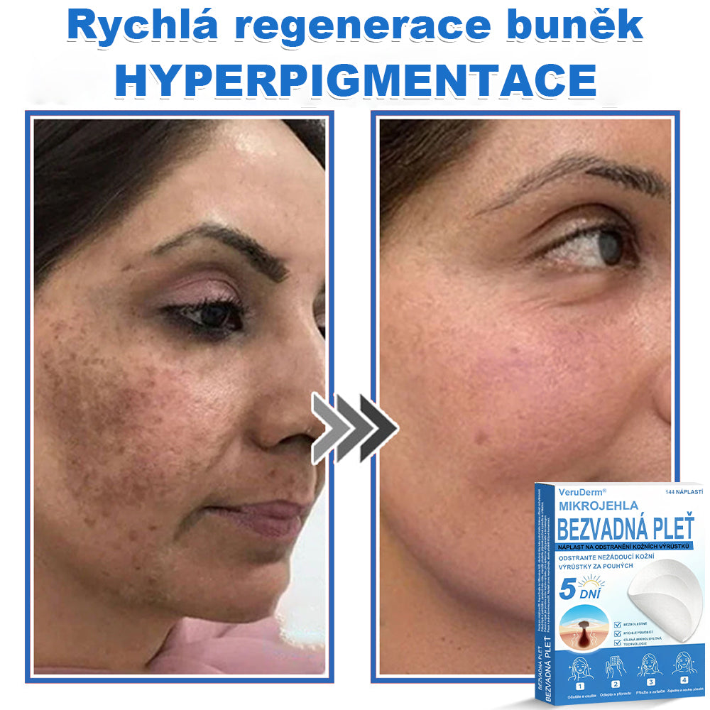 VeruDerm® 2v1 mikrojehličková a hydrokoloidní náplast | Cílená péče o kožní výrůstky, pupínky, ploché bradavice a drobné nedokonalosti ✅ | Pomáhá zjemnit vzhled vrásek, jizev a nerovností pleti ✨ | Diskrétní náplast na obličej i tělo | 144 ks