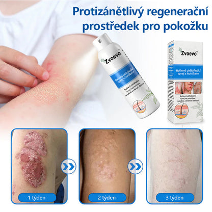 💪 Oficiální obchod: Twisma® Magnesium bylinný sprej na lupénku ✅ CE certifikace (zmírňuje lupénku a ekzém, léčí akné a bradavice, podporuje hojení bakteriálních infekcí, snižuje kloubní a neuropatickou bolest)